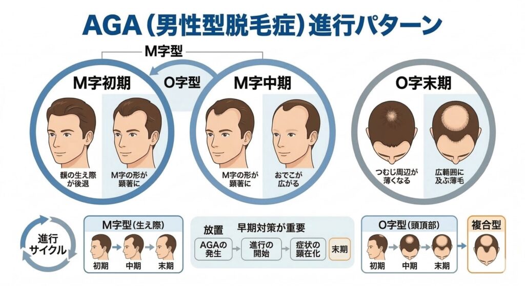 AGA（男性型脱毛症）の進行パターン｜M字型・O字型の薄毛